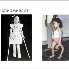 Полиомиелит
