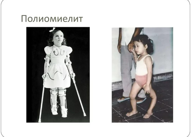 Полиомиелит